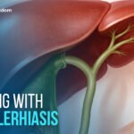 Living With Cholerhiasis